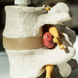 Bandscheibenbedingte und chronische Rückenschmerzen
